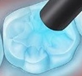 dentalsealantapplication-CureLight-Cropped