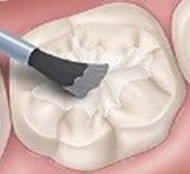 dentalsealantapplication-Brush-Cropped