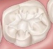 dentalsealantapplication-Finished_Cropped