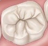 dentalsealantapplication-cropped